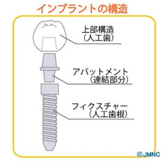 インプラントの治療費の仕組み