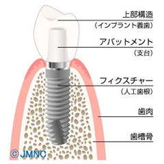 インプラントの治療費の仕組み