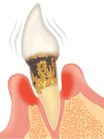 歯周病とは？
