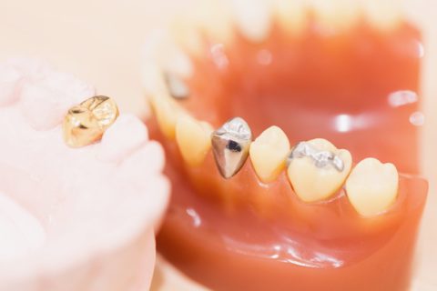 タチバナ歯科医院補綴物